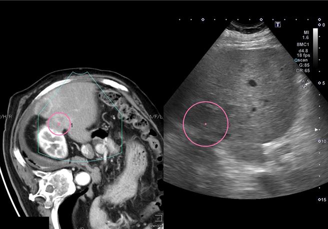 台中72岁张老板早年常应酬喝酒拚业绩，10年前罹患肝癌以手术切除8公分肿瘤，多年前復发以拴塞、放疗及标靶药物治疗控制，没想到近日三度復发，再採烧灼、免疫疗法治疗，仍维持良好生活品质。（亚大医院提供／潘虹恩台中传真）