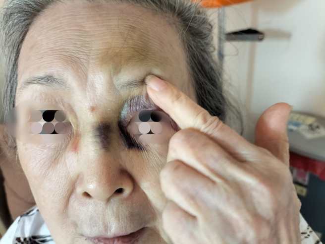 蘇一峰分享老太太染疫後摔倒的狀況。（翻攝自蘇一峰臉書）