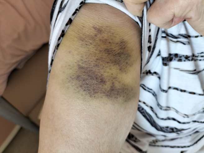 蘇一峰分享老太太的傷勢。（翻攝自蘇一峰臉書）