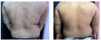 從抓痕到康復 14歲少年患異位性皮膚炎治療之旅