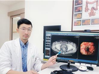 血便以為痔瘡 買藥膏擦不好 醫一查：大腸癌3期