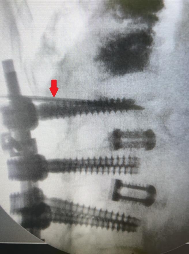82岁奶奶因手术空间狭小，在X光机导引下，以细小钢针(箭头处)顺利完成手术。（大千医院提供／谢明俊苗栗传真）