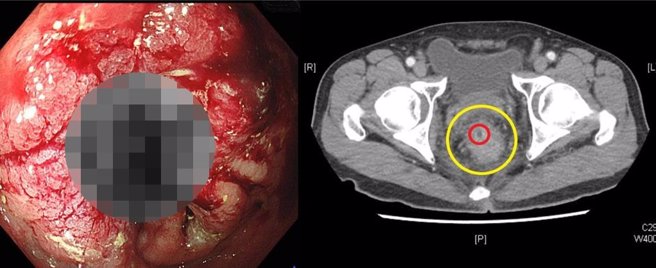 藉由大肠镜影像可看出直肠癌造成出血，电脑断层（右图) 黄圈处为肠道原始大小，因恶性肿瘤阻塞造成肠道管径变小至红圈处，导致排便困难。.（土城医院提供）