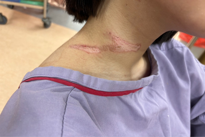 徐姓女骑士脖子留下的伤痕触目惊心。（图 / 民眾提供）