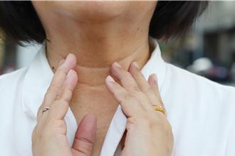 女大生體檢查出甲狀腺結節勇敢切除 醫揭1年齡層女性好發