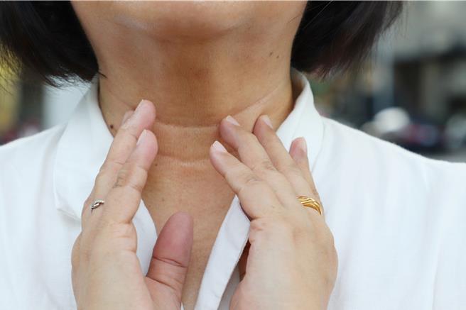 仁愛長庚合作聯盟醫院一般外科主任巫奕儒1日指出，甲狀腺結節好發於20至45歲女性，通常會出現頸部有壓迫感及吞嚥困難等症狀，提醒民眾注意並定期接受健康檢查。（仁愛長庚合作聯盟醫院提供／潘虹恩台中傳真）