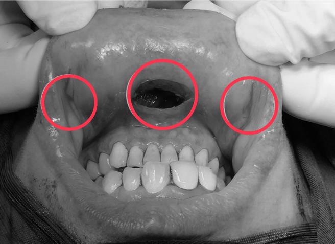 胡姓女大生日前體檢發現甲狀腺結節，以自然孔洞達文西甲狀腺手術進行切除，確認為惡性乳突狀甲狀腺癌，幸腫瘤小於1公分且無淋巴轉移，預後良好，也僅在口腔及臉頰內側有3處傷口。（仁愛長庚合作聯盟醫院提供／潘虹恩台中傳真）