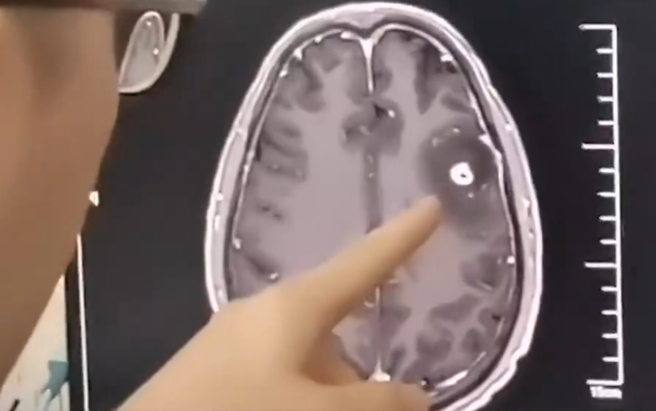 大陸有6旬男子過年被叫去喝「生豬血」，導致他時常暈倒，到醫院檢查後發現「腦袋爬滿寄生蟲」。（圖／翻攝自微博）