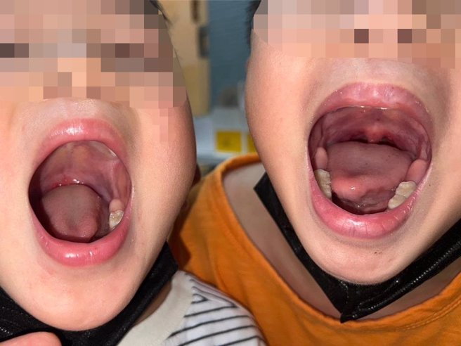 腸病毒疫情未趨緩，台中市1對6歲、3歲的兄弟檔日前接連感染腸病毒，幸經治療後好轉。（施勝桓提供／潘虹恩台中傳真）