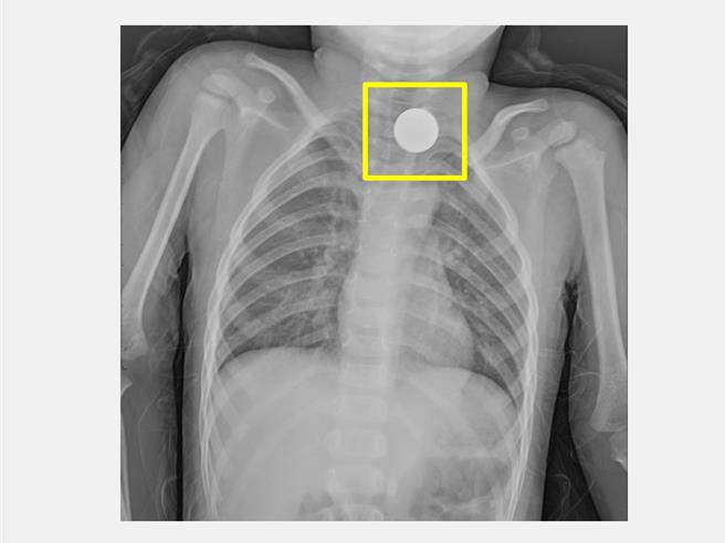 台中3歲男童日前疑似吞入異物出現喉嚨痛和吞嚥不適，被送到仁愛長庚合作聯盟醫院急診室，照X光查出其食道處有一環狀扁平異物，緊急安排全身麻醉腸胃鏡異物夾取術取出1元硬幣。（仁愛長庚合作聯盟醫院提供／潘虹恩台中傳真）