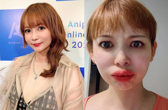 宅男女神唇腫5倍變「香腸嘴」 驚悚病況引網憂：惡化恐奪命