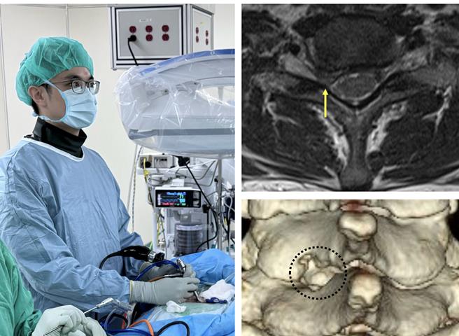 神经外科医师徐秋豪为病人执行内视镜椎间盘切除手术，术前核磁共振显示椎间盘突出（箭号）。（新竹台大分院提供／邱立雅竹县传真）