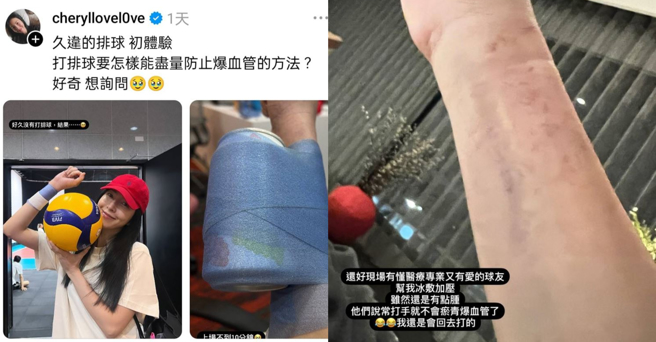 楊謹華打排球「靜脈血管爆掉」，曝傷勢照。（圖／翻攝自IG 楊謹華）