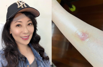 况明洁不甩小黑蚊叮咬「手肿包子大」　医丢6字吓坏她：别铁齿