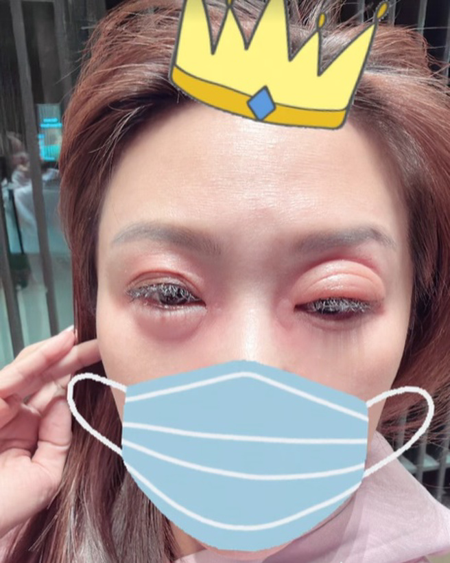 佩甄肿到双眼几乎睁不开。（图／sleepyjane415 IG）