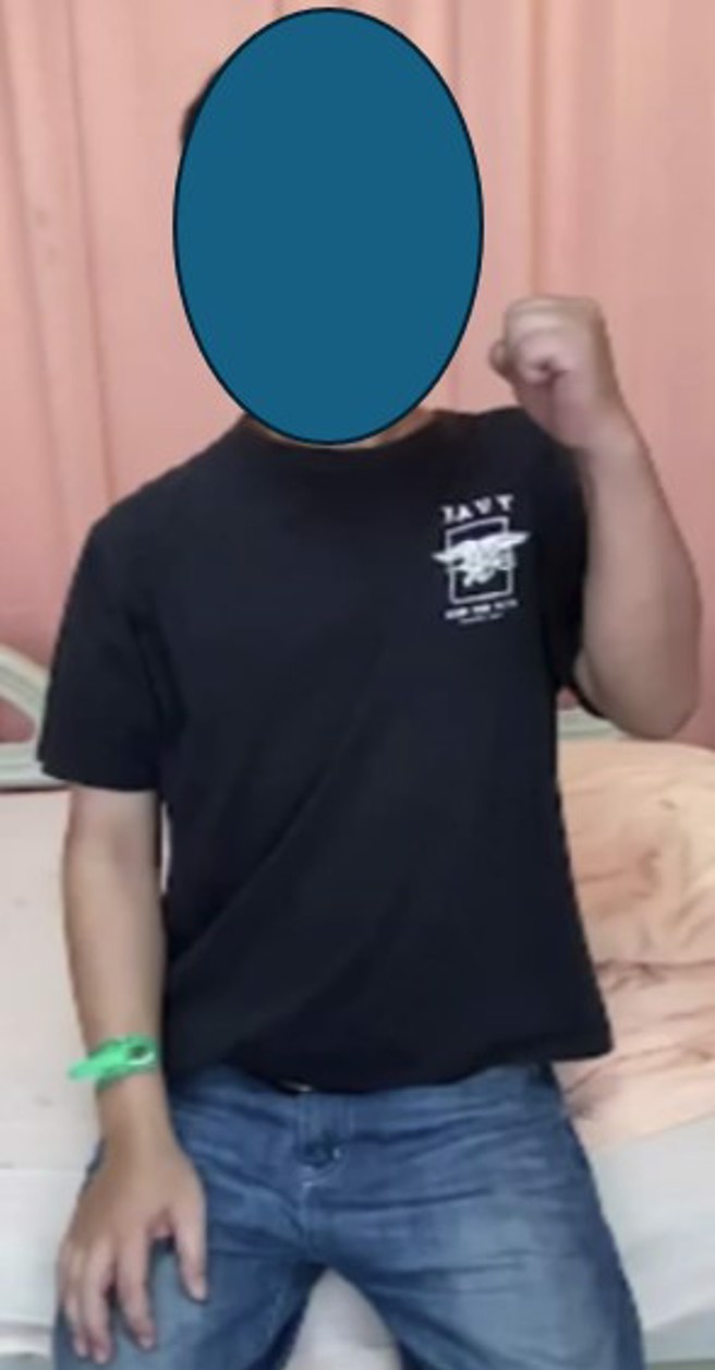 一名男子左肩发生臂丛神经炎后，使尽力气，左肩都抬不起来。图中案例与文中案例无关。（图／黄惠鑛医师提供）