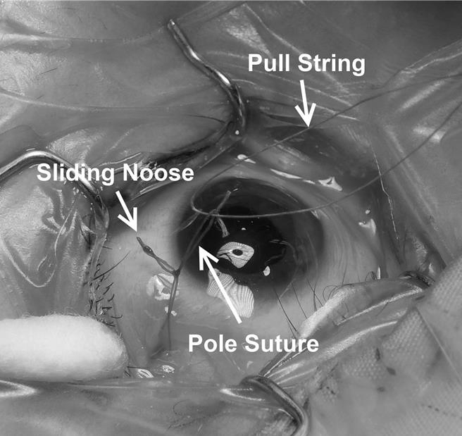 可调式斜视手术，术中以滑动套结放松或加强眼球肌肉以调整眼位。（嘉义基督教医院提供∕吕妍庭嘉义传真）