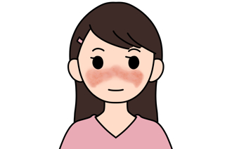 红斑性狼疮致病原因找到了！ 治疗终于有线索 