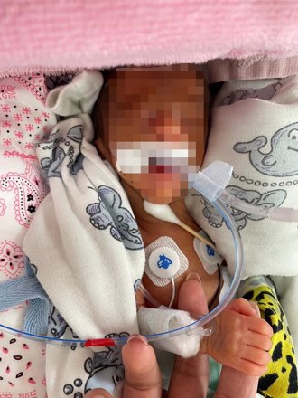 880克巴掌宝宝战胜死神！圣保禄医院最小早产儿健康出院