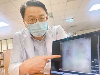 凱米遠離 醫籲防登革熱疫情爆發