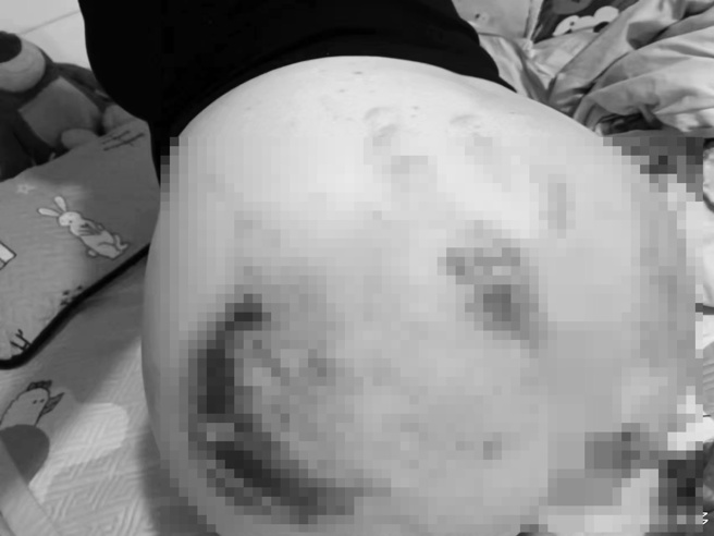 年轻女子在乘坐男性友人的重机出游时，臀部遭到重机轮胎的重创，伤势严重。（翻摄微博）