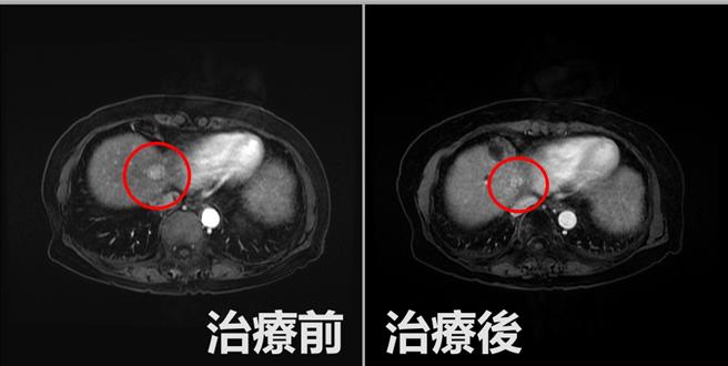83歲廖姓阿嬤去年初發現肝癌復發，採拴塞、放療緩和療法成功清除肝癌細胞，圖為治療前後對照。（亞大醫院提供／馮惠宜台中傳真）