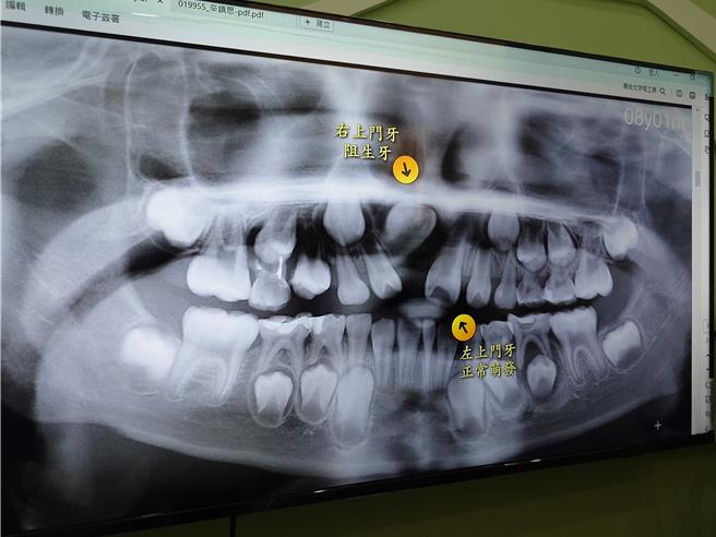 高雄1名小学生门牙迟迟少1颗，经照X光才发现是「阻生齿」作祟，经12个月治疗恢復健全牙齿。（任义宇摄）