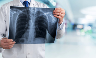 每年新增1.4萬人確診肺癌 「LDCT篩檢」擴大年齡層