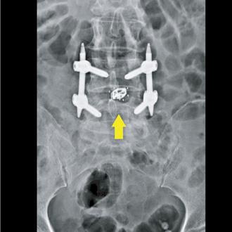 腰痠背痛腳麻木？小心是腰椎滑脫 新手術助婦重獲新生