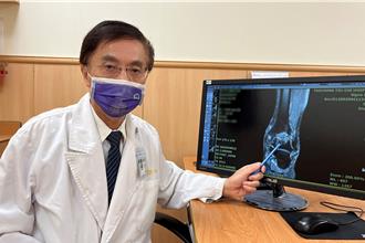 自體血小板修復關節 8旬泥水匠不再為雙腳疼痛而苦