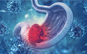 健保放寬幽門桿菌除菌治療 9縣市8月起試辦糞便篩檢