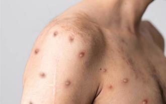 台南增3例M痘本土病例 衛生局：7國旅遊注意