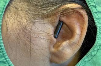 妇人踩空撞餐桌 「筷子插耳」深入头皮2.5公分