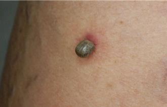 高雄翁遊日遭蜱蟲盯上 左小腿長「息肉」就醫才發覺