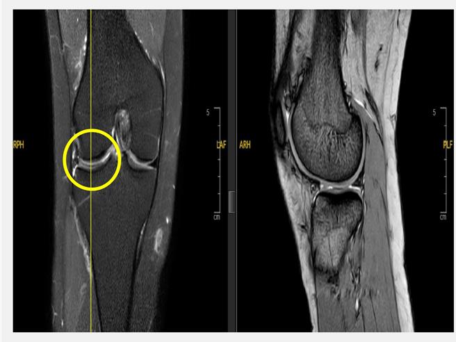 38歲男子打籃球造成右膝受傷，經核磁共振顯示，病患膝蓋外側半月板破裂（左圖圓圈處）。（仁愛長庚合作聯盟醫院提供／馮惠宜台中傳真）