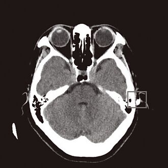 新北 妇跌倒木筷插耳 医紧急拔除