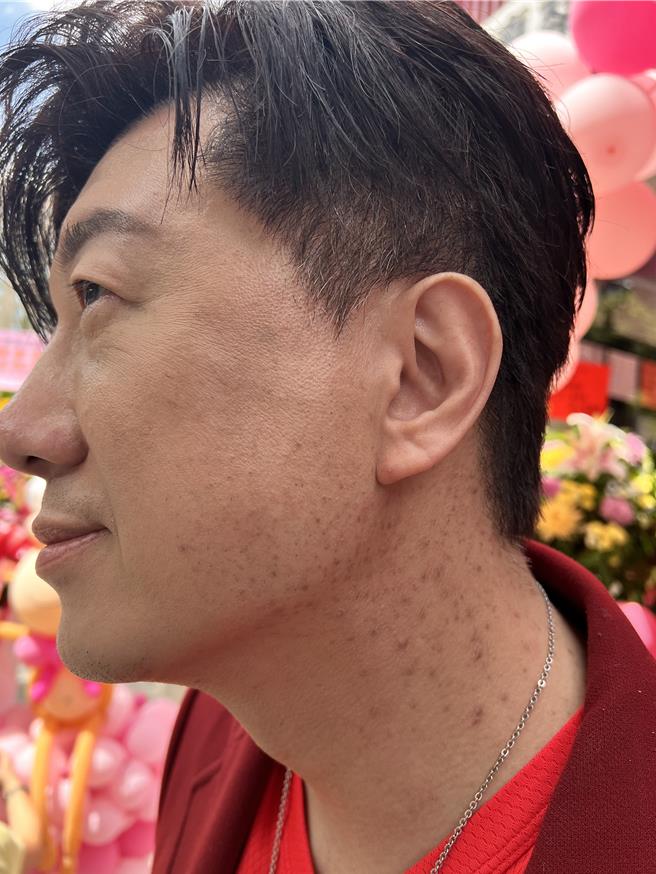 吴皓升因女儿长了一大片毛囊炎。（民视提供）