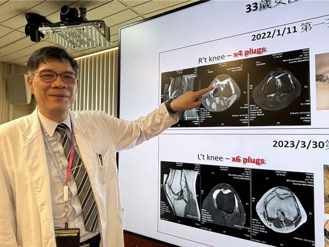 台中榮總骨科部運動醫學科代主任陳超平解說，手術後經核磁共振可見軟骨修復情形。（馮惠宜攝）