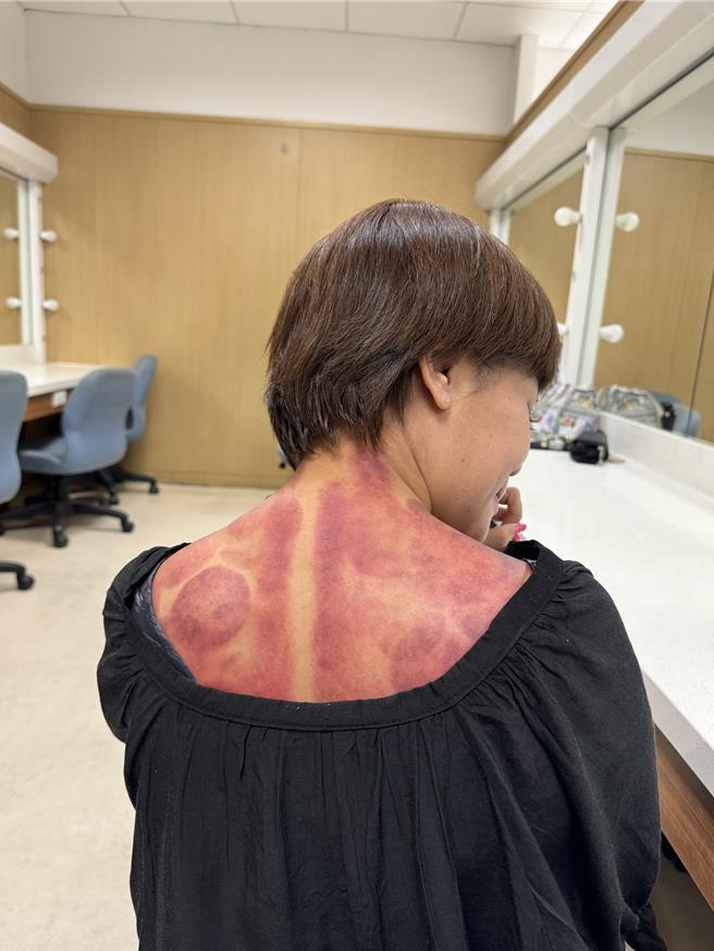 锦雯拍戏中暑，背部刮出大片痧。（民视提供）