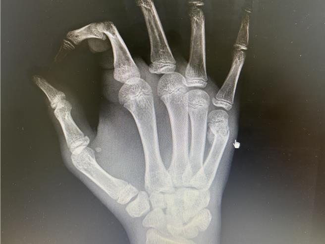 高雄一名国中生看林郁婷在巴黎奥运的金牌战期间，见其夺金牌情绪太激动搥打墙壁，却造成右手掌出现典型「拳击手骨折」。（中正脊椎骨科提供／任义宇高雄传真）