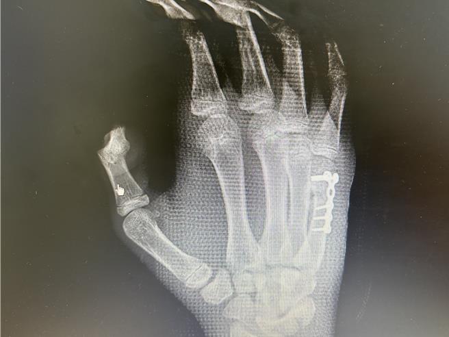 医师透过钢板固定，让国中生手掌顺利恢復。（中正脊椎骨科提供／任义宇高雄传真）