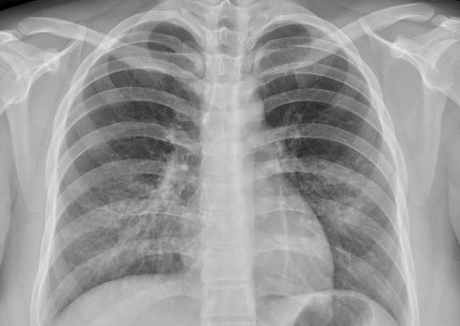 胸腔科医师苏一峰分享，一名年仅20岁的年轻女性因为抽电子烟导致肺炎、咳血，提醒电子烟与传统纸菸对人体危害都相当大。（图／翻摄自苏一峰脸书）