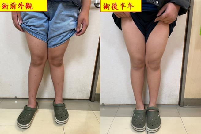 張小弟接受導引式鋼板矯正手術治療，手術後短短半年，雙腿外觀已顯著改善，術後一年，量測發現膝蓋角度恢復正常，外觀與功能皆有明顯改善。(中醫大附醫提供／馮惠宜台中傳真)