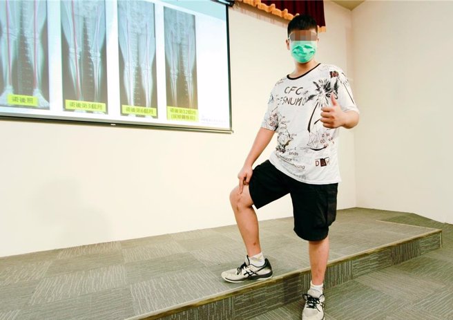 張小弟接受導引式鋼板矯正手術治療，手術後短短半年，雙腿外觀已顯著改善，術後一年，量測發現膝蓋角度恢復正常，外觀與功能皆有明顯改善。(中醫大附醫提供／馮惠宜台中傳真)