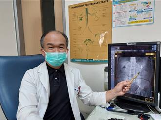 7旬男腹痛檢出4公分鹿角結石 醫給4建議防結石反覆發生