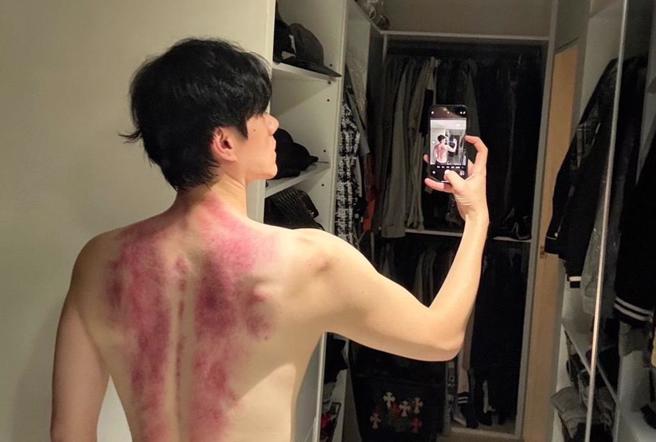 李程彬背部刮痧後的模樣很驚人。 (東旭九翔娛樂提供) 