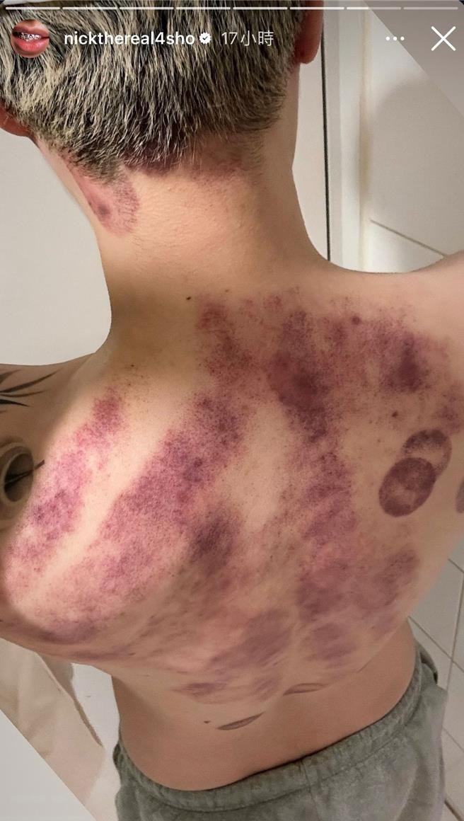 周汤豪晒出请师父帮他刮痧、拔罐后的照片。（摘自IG）