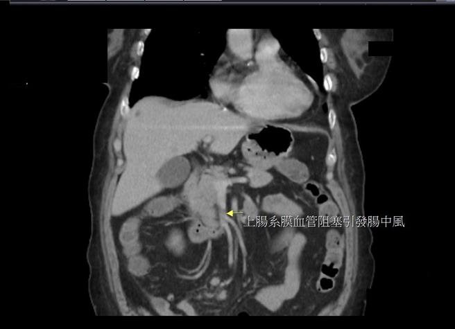 杨姓老妇经检查发现为罕见的肠中风（黄色箭头处）。（大千医院提供／谢明俊苗栗传真）