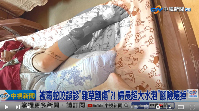 高雄一名婦人左腳腫脹疼痛到岡山秀傳就醫，醫院卻開出「雜草割傷」轉診單，事後證實是龜殼花咬傷，讓家屬痛批太離譜。(圖／中視新聞)