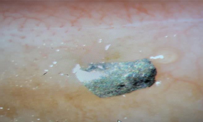 中秋烤肉突掀大风，28岁女子左眼随风吹入黄色小虫、铝箔纸、木炭，就医治疗已痊癒。（画面翻摄／纪爰高雄传真）